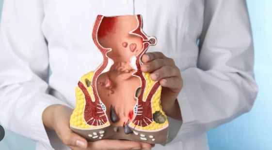 Diosmin For Hemorrhoids Diosmin For Hemorrhoids